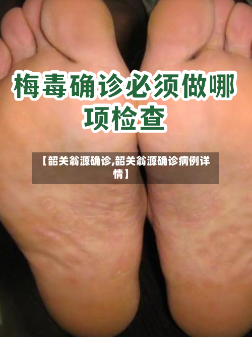 【韶关翁源确诊,韶关翁源确诊病例详情】