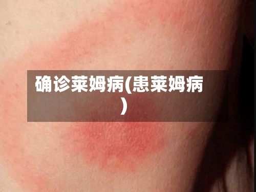 确诊莱姆病(患莱姆病)