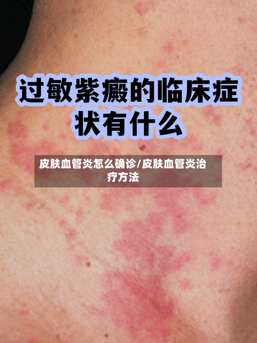 皮肤血管炎怎么确诊/皮肤血管炎治疗方法