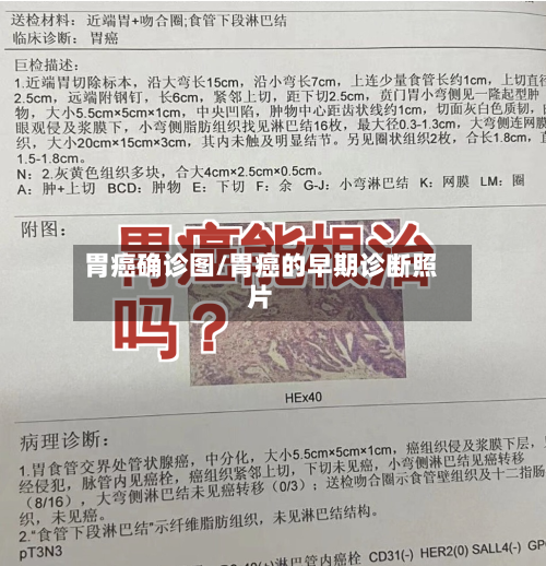 胃癌确诊图/胃癌的早期诊断照片