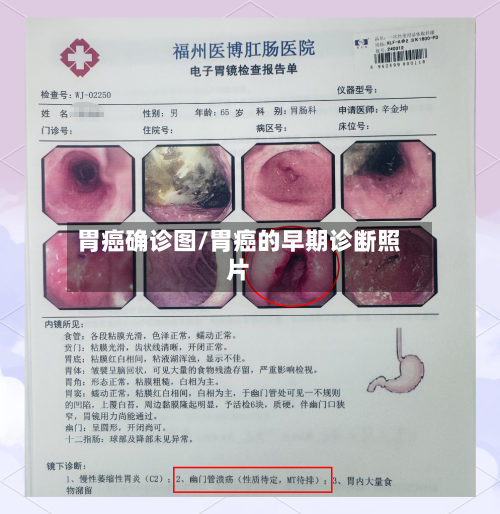 胃癌确诊图/胃癌的早期诊断照片