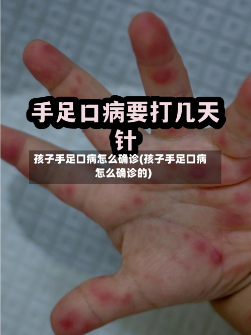 孩子手足口病怎么确诊(孩子手足口病怎么确诊的)