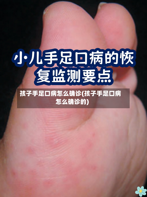 孩子手足口病怎么确诊(孩子手足口病怎么确诊的)