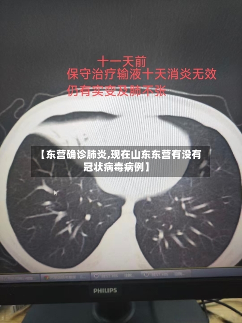 【东营确诊肺炎,现在山东东营有没有冠状病毒病例】